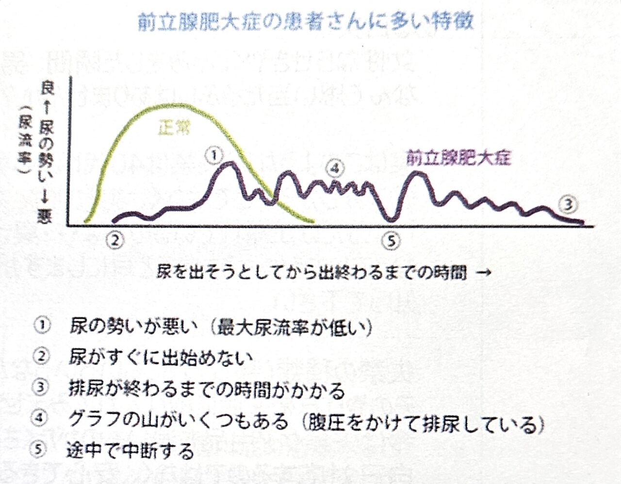 前立腺肥大症の排尿特徴